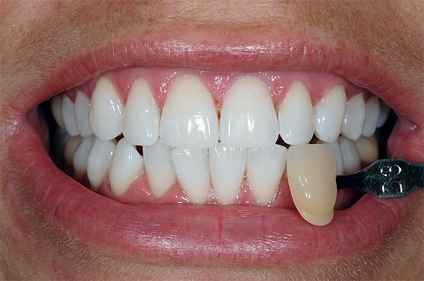 After teeth Whitening at West Dulwich Dental