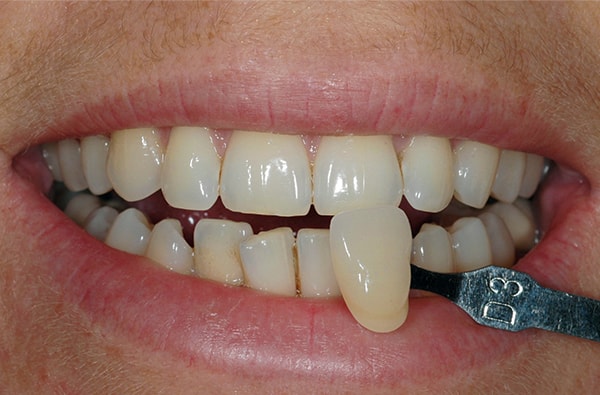 Before teeth Whitening at West Dulwich Dental