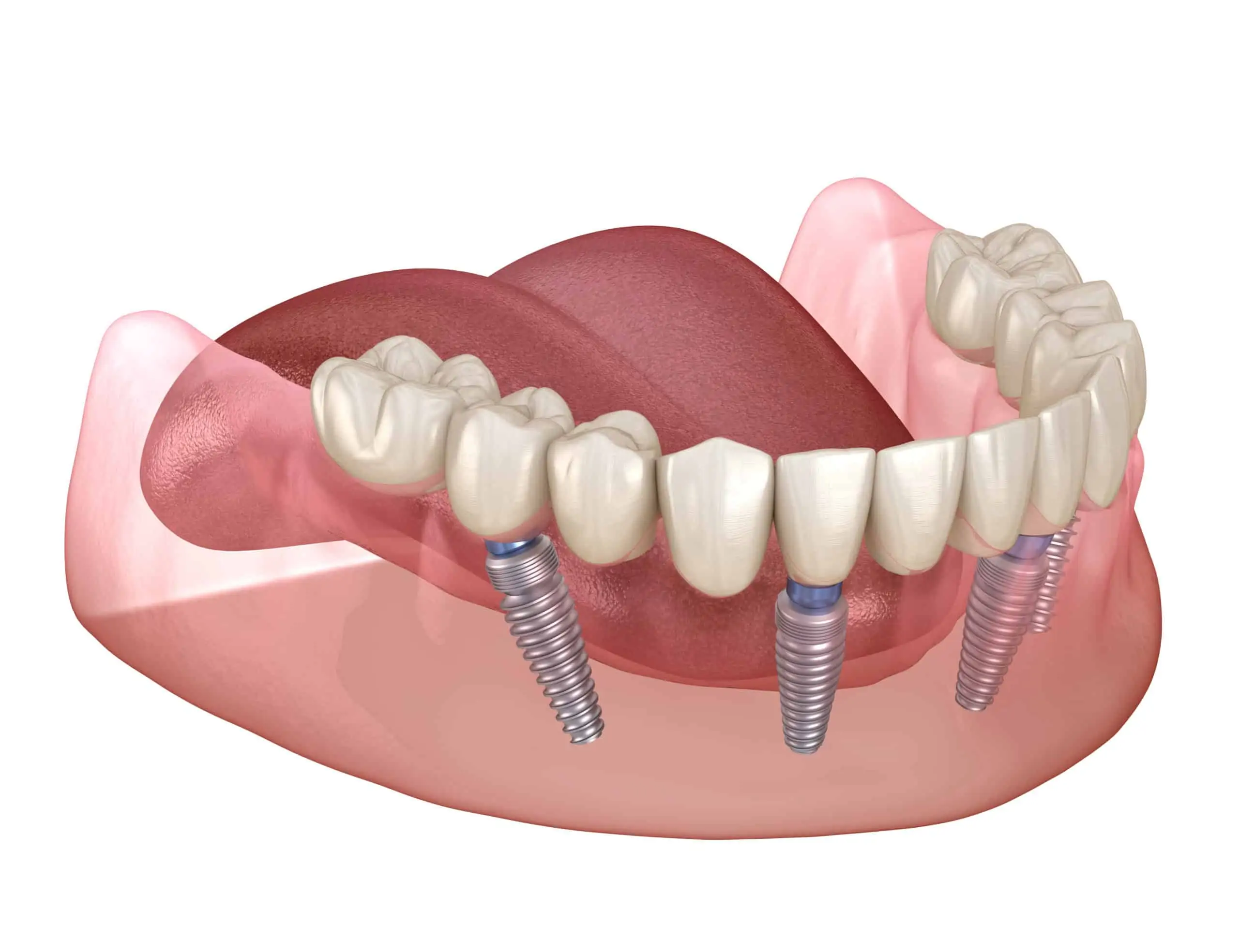 dental implant sydenham