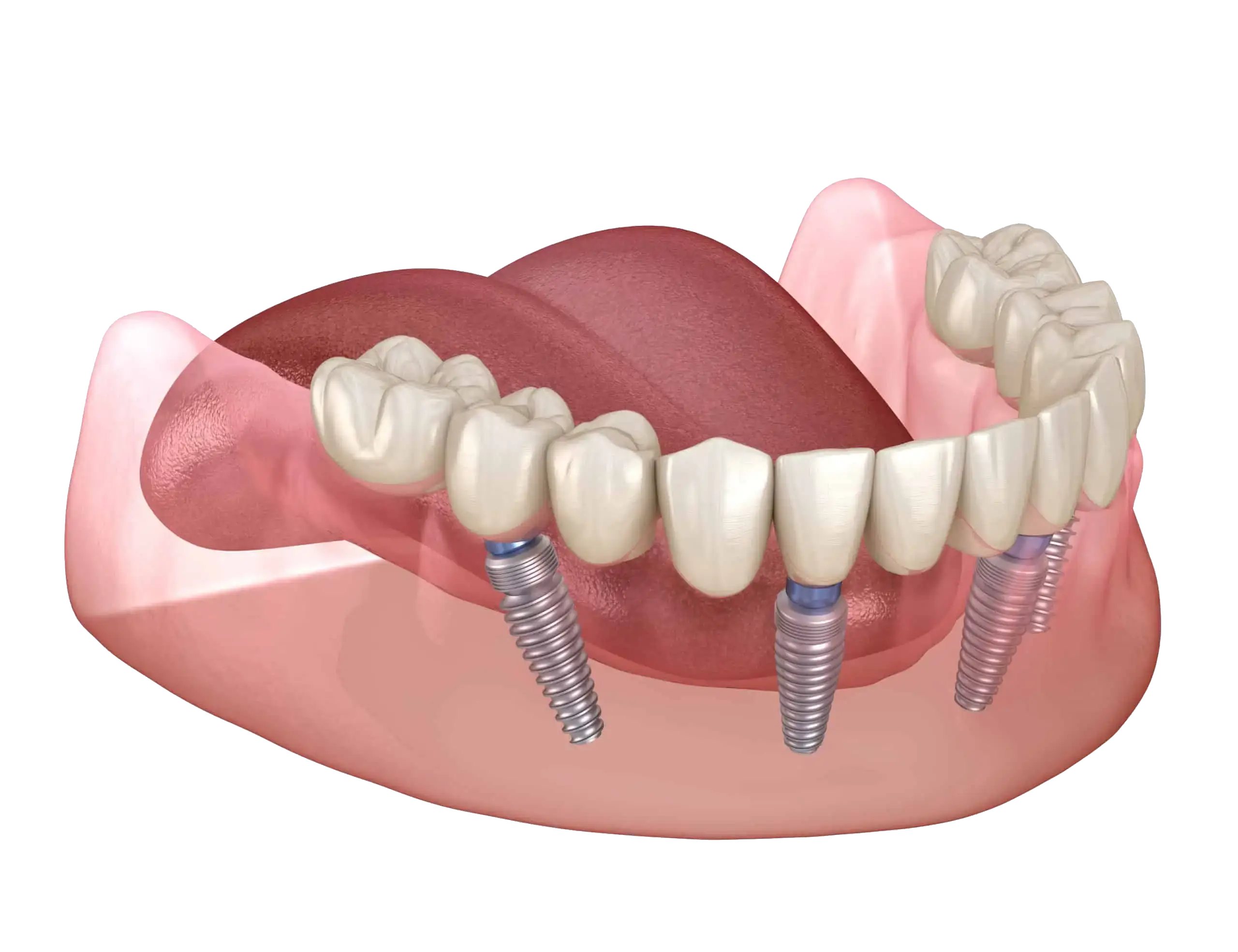 all-on-4-implants-scaled