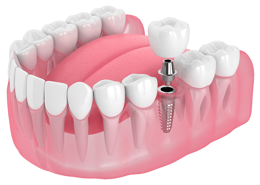 dental implants west norwood dental implants west norwood